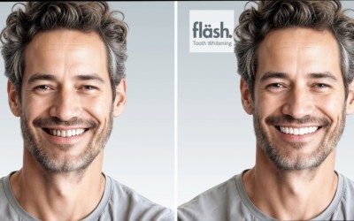 Izbeljivanje zuba - Stomatolozi veruju. Pacijenti vole.