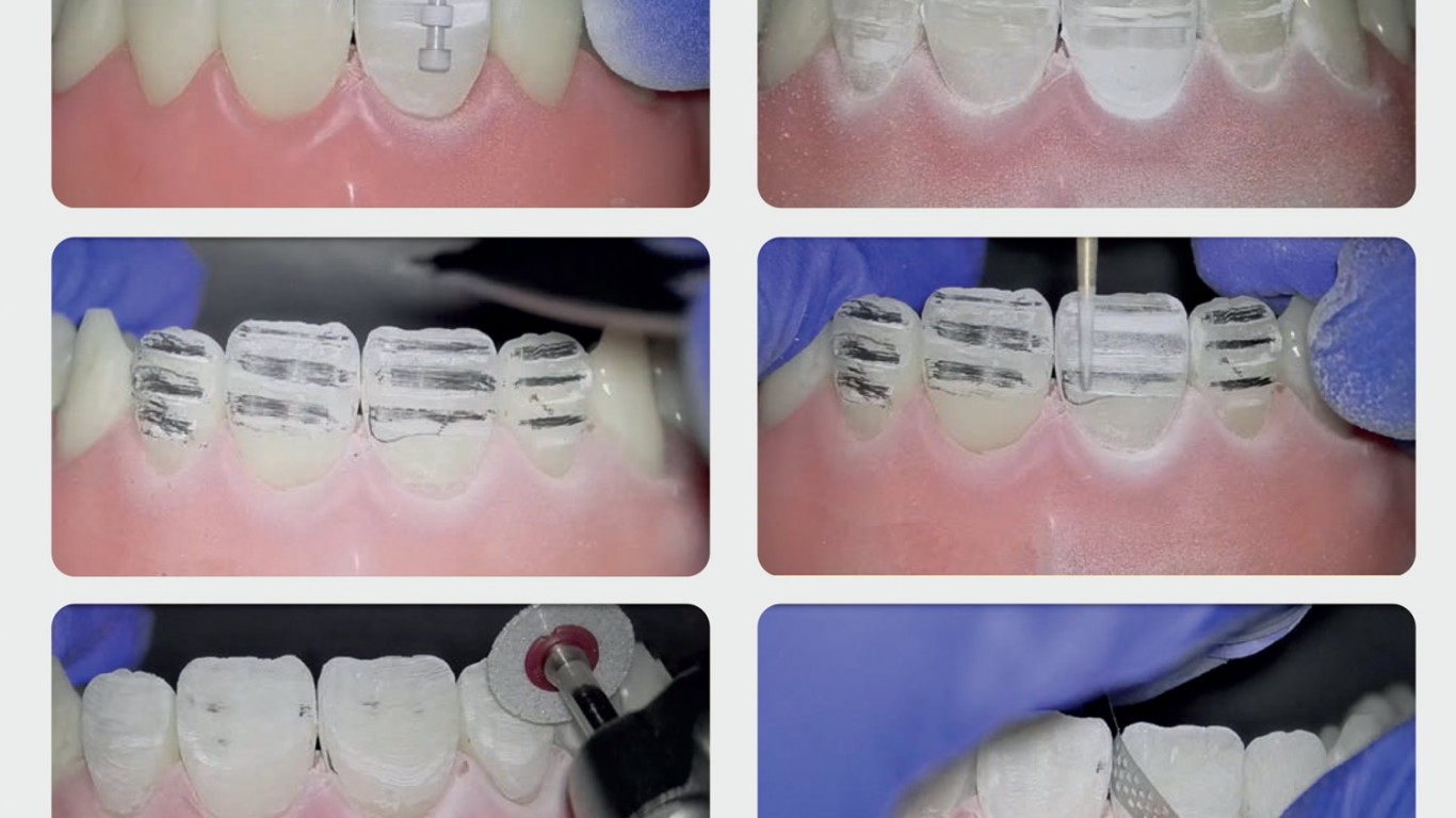 Direktni Viniri primenom „copy & flask“ tehnike