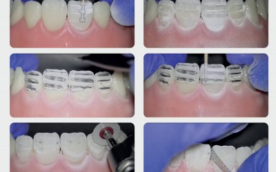 Direktni Viniri primenom „copy & flask“ tehnike