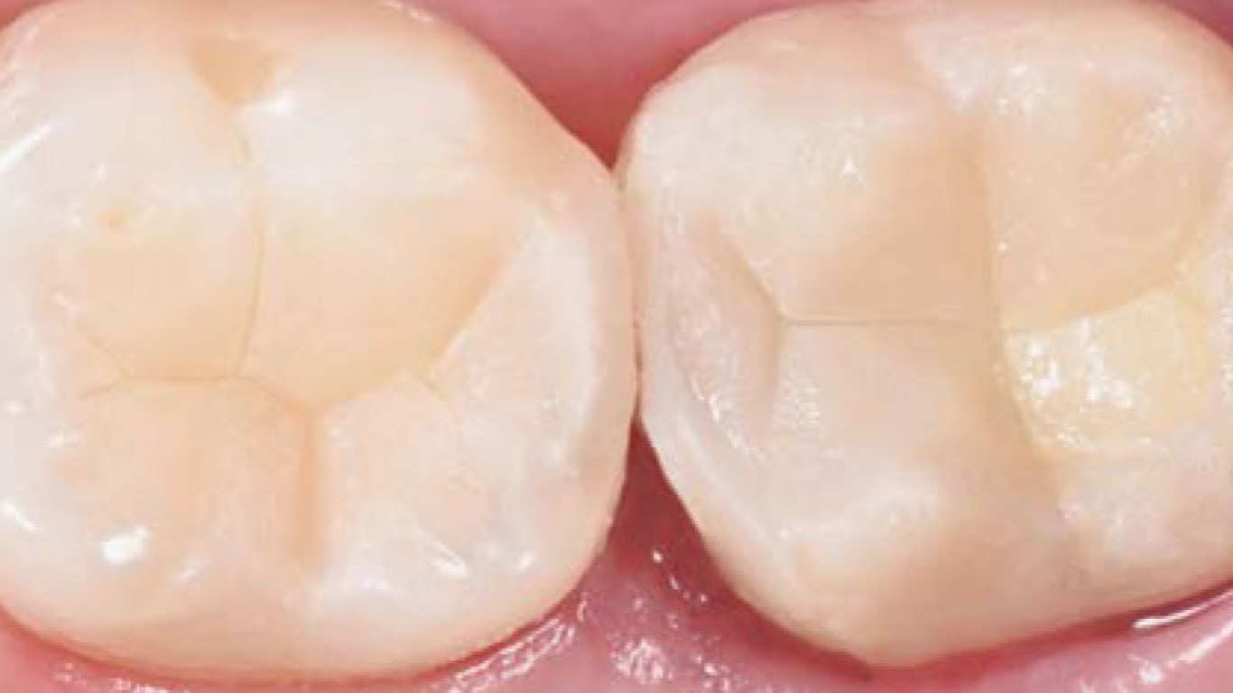 INDIREKTNO PREKRIVANJE PULPE - Bio-Bulk Fill tehnika i Bulk&Go