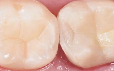 INDIREKTNO PREKRIVANJE PULPE - Bio-Bulk Fill tehnika i Bulk&Go