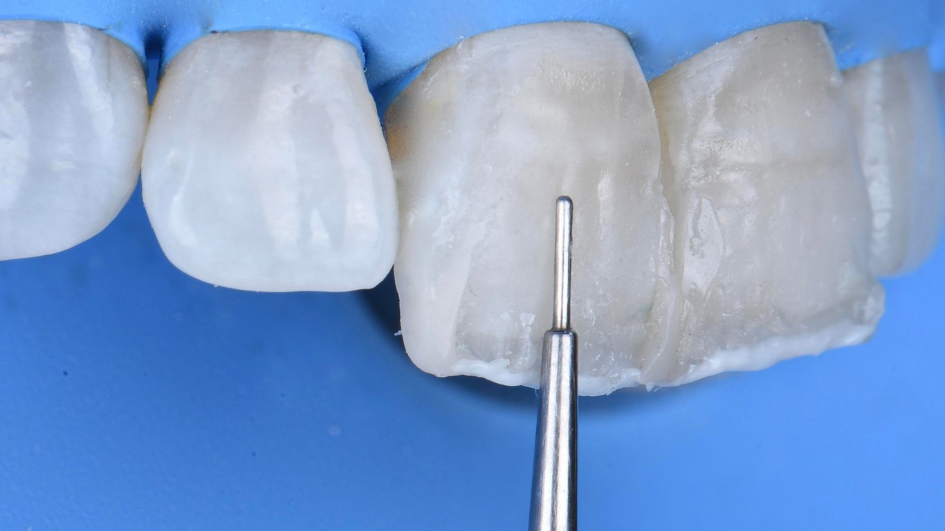 Precizna instrumentacija, predvidivi kompoziti i laka tehnika za direktne restauracije klase IV u jednoj poseti - dr Ajay Juneja