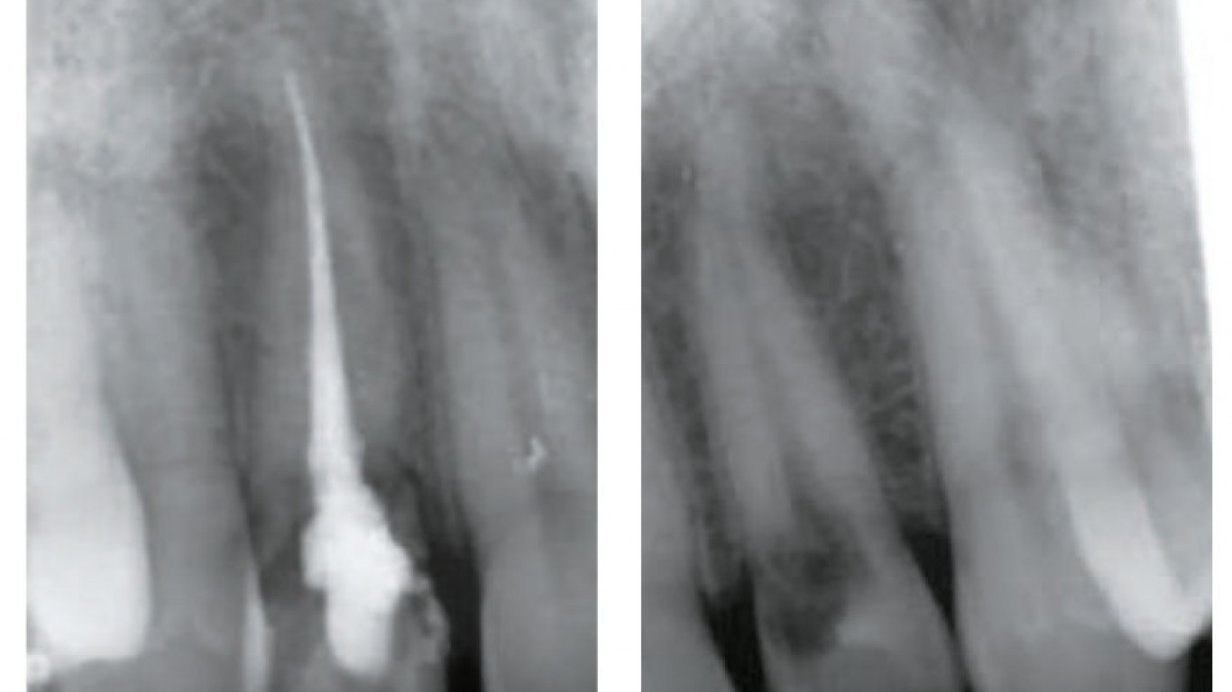 Kliničke prednosti „socket-shield“ tehnike i iPhysio® abatmenta