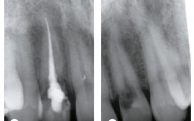 Kliničke prednosti „socket-shield“ tehnike i iPhysio® abatmenta