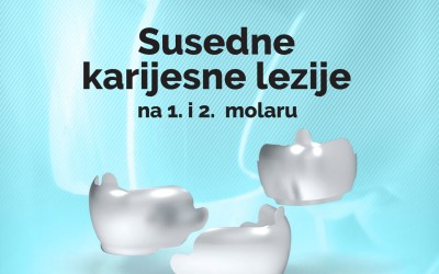 Susedne karijesne lezije na 1. i 2. molaru