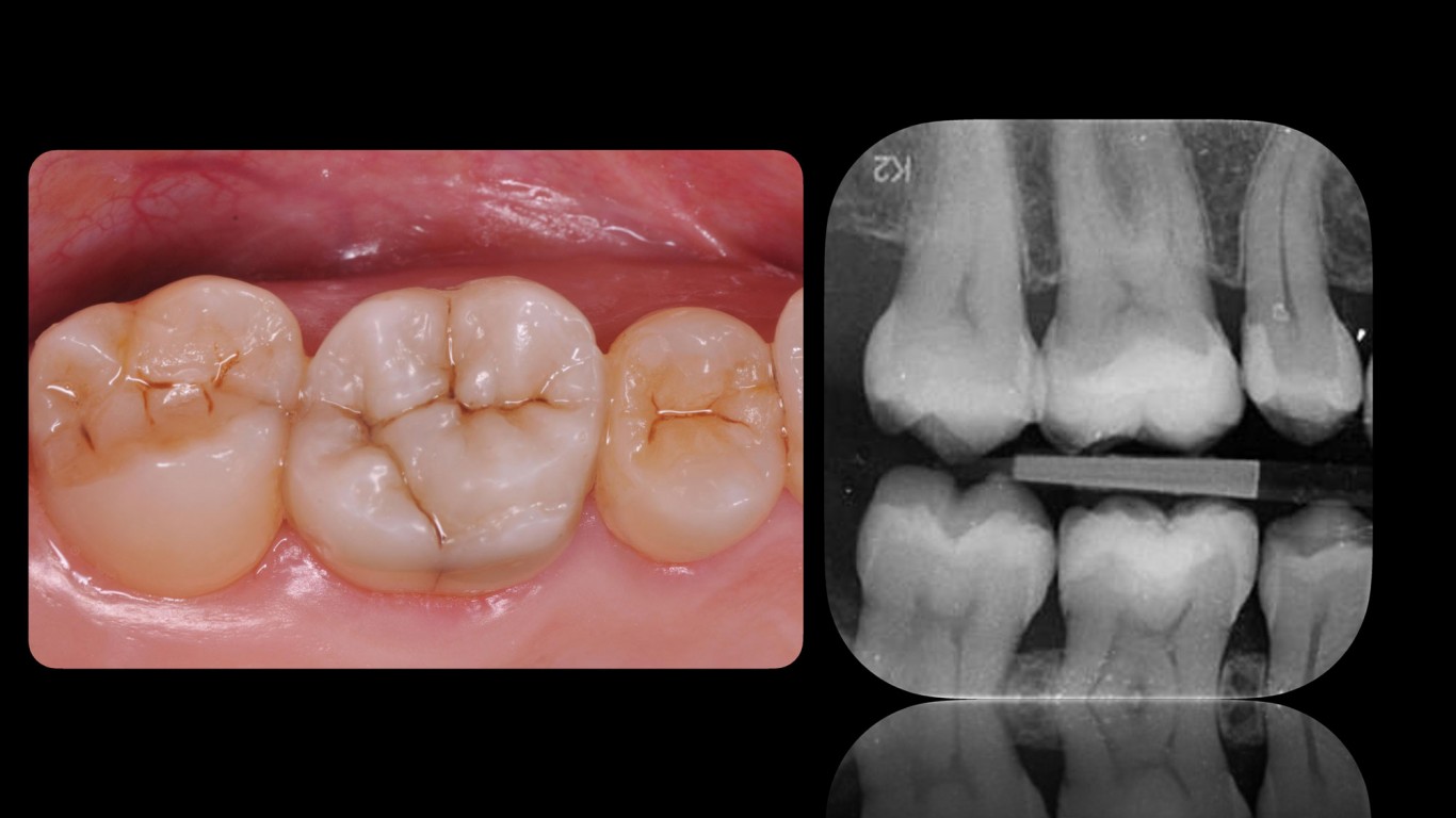 Svestranost u restaurativnoj stomatologiji: Bulk-Fill i kombinovana tehnika