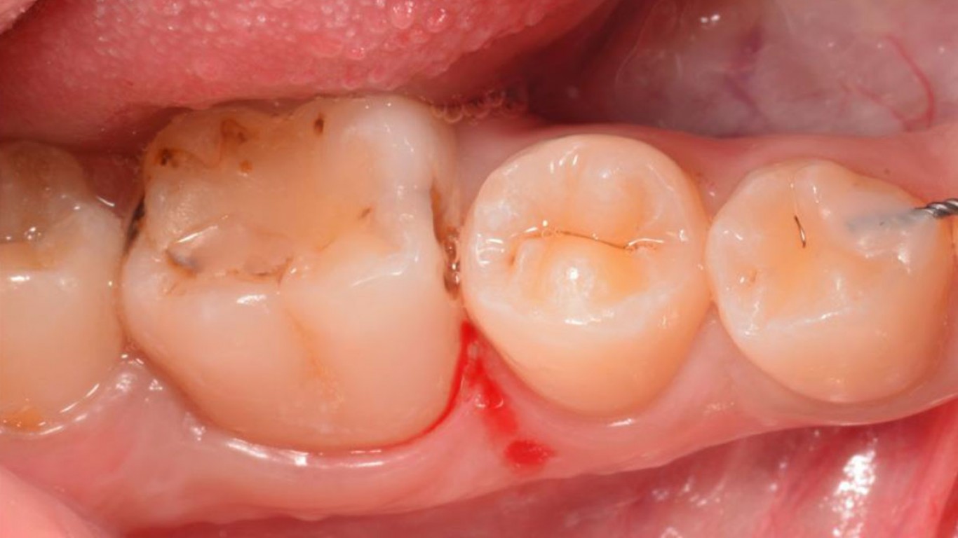 Zamena starog kompozita i direktna restauracija kaviteta klase II na stalnom molaru