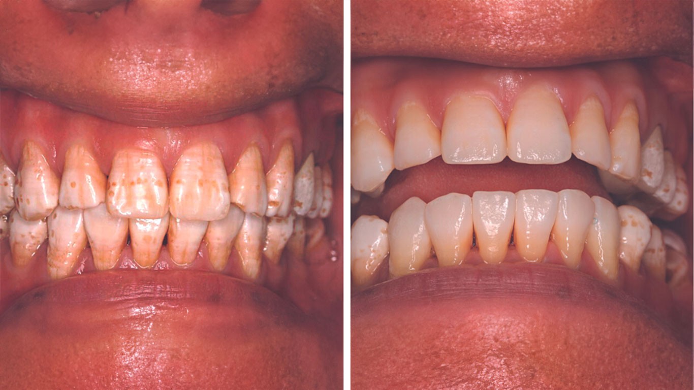 Minimalno invazivna estetska restauracija teške dentalne fluoroze – kombinacija infiltracije smolom i kućnog beljenja