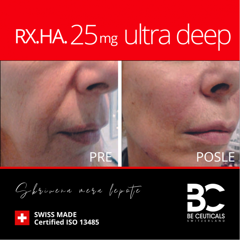 Hijaluronski Filer Rx.ha.25Mg - Ultra Deep
