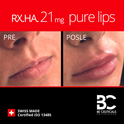 Hijaluronski filer RX.HA.21mg - balance/lips pakovanje (2ml)