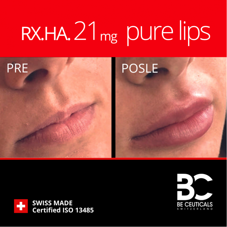 Hijaluronski Filer Rx.ha.21Mg - Balance/Lips