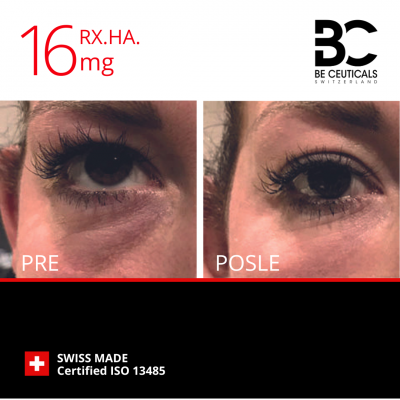 Hijaluronski filer RX.HA.16mg - first lines pakovanje (2ml)