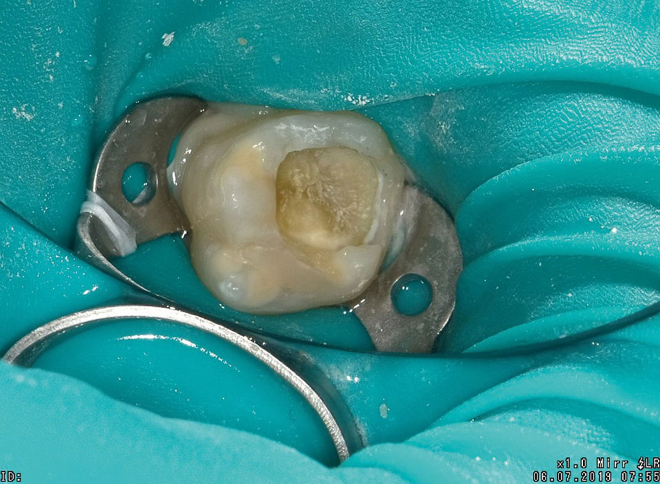 Slika 5 - Klinička situacija nakon uklanjanja razmekšalog dentina